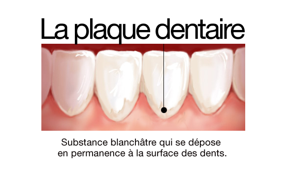 Plaque dentaire