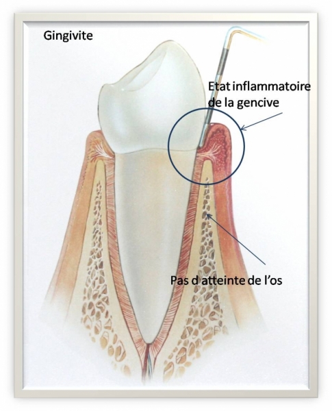gingivite