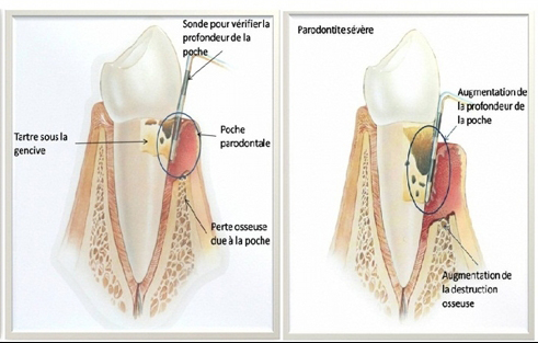 la parodontite