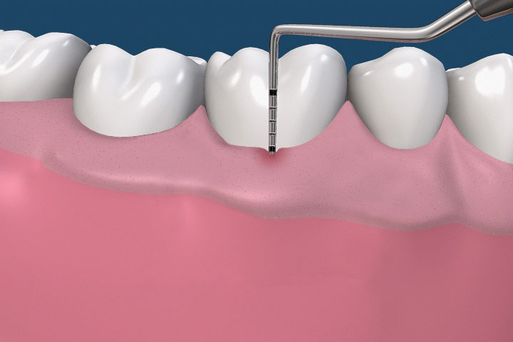 periodontist-probe-naples